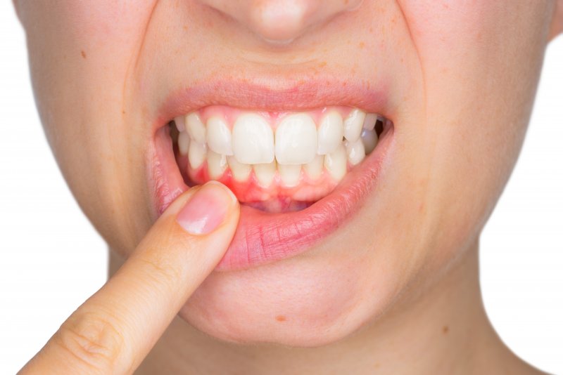 Woman pulling down lower lip revealing inflamed gums