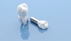 single dental implant; blue background