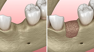 digital illustration of a bone graft for dental implants in Belmont