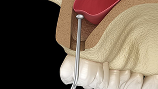 Digital illustration of a sinus lift for dental implants in Belmont 