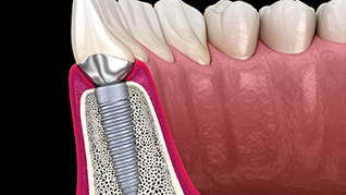 Digital illustration of a ridge expansion for dental implants in Belmont
