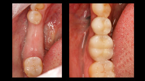 before and after teeth replacements