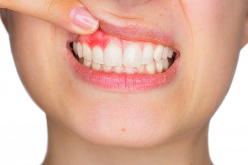 Pushing up upper lip to show signs of gum disease