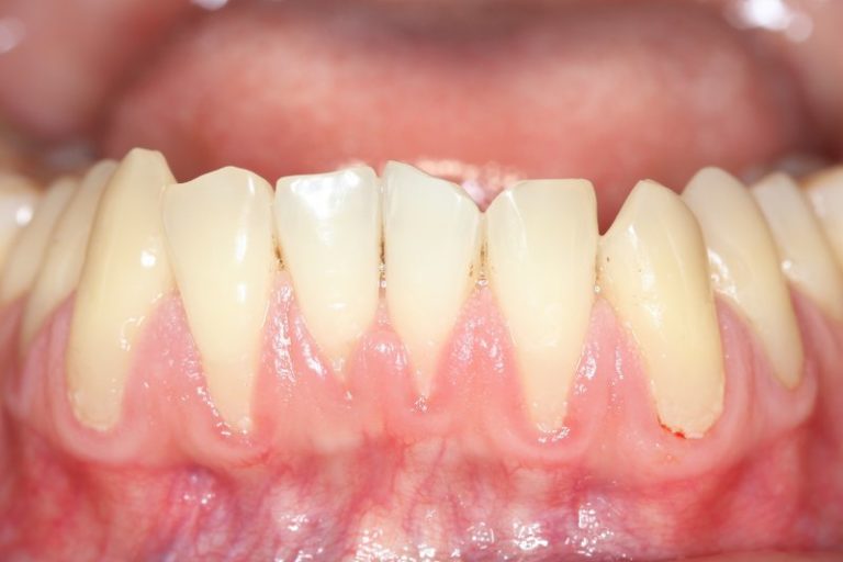 Gum Recession Belmont Alexander Schrott Periodontics And Implants