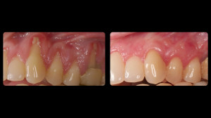 Before and after crown lengthening treatment